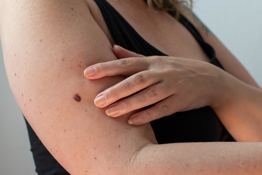 woman checking her skin for abnormal moles which may be melanoma skin cancer