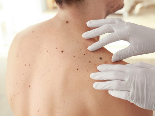 Getting A Biopsy Test in Texas: Early Detection for Skin Cancer