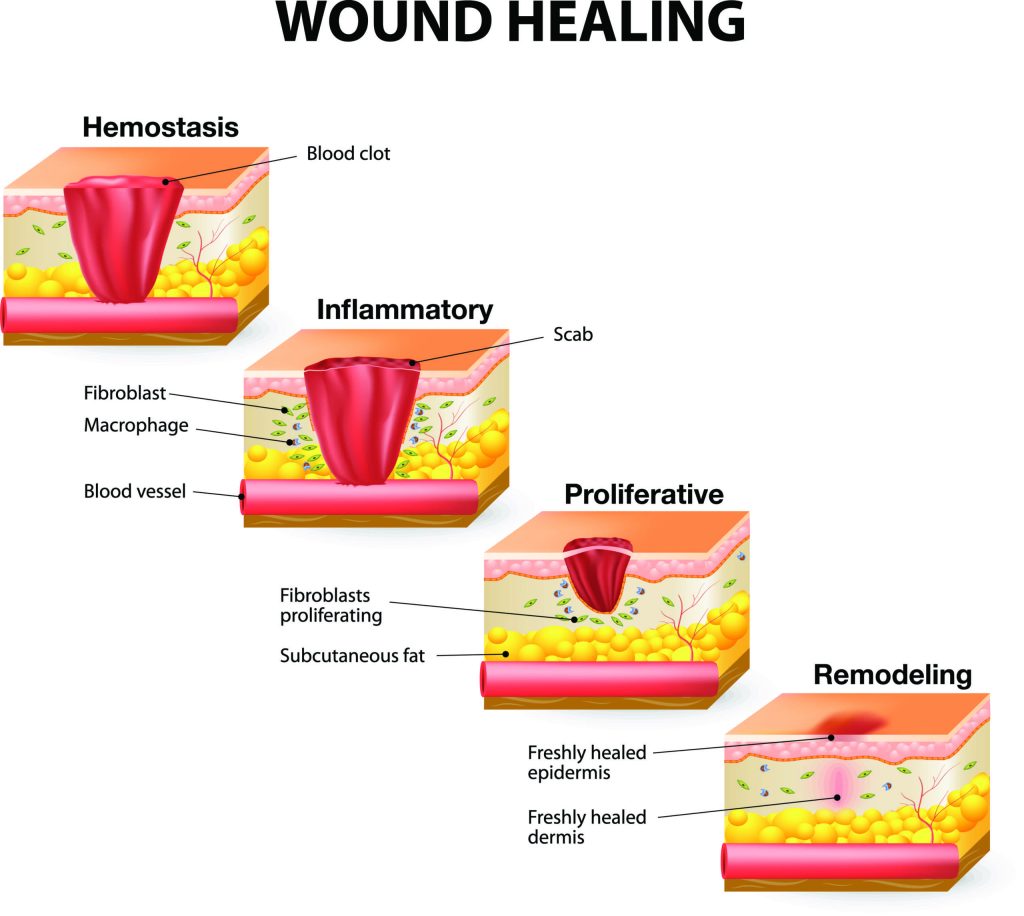 The 4 phases of wound healing. Healing begins with Hemostasis, 2defensive/inflammatory phase, 3 proliferative phase, 4 maturation phase.