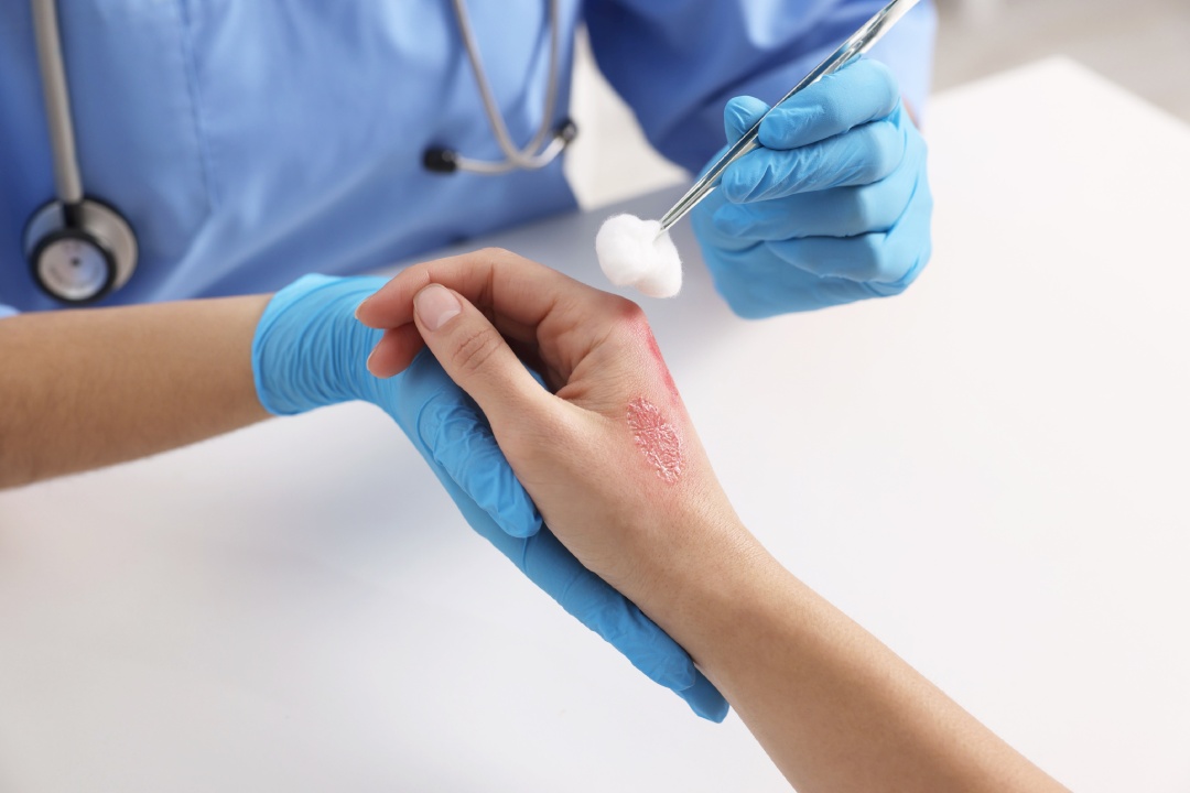 Doctor treating patient's burned hand at table, closeup